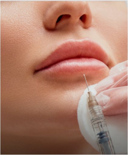 Lip filler injection with a syringe for natural-looking volume