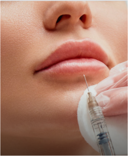 Lip filler injection with a syringe for natural-looking volume