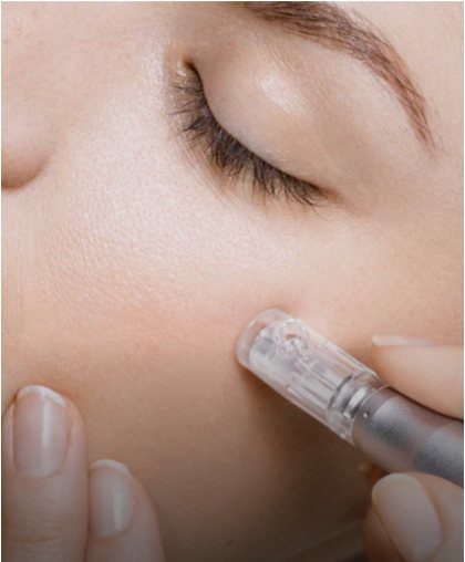 Close-up of a microneedling pen treating the skin on a client's cheek