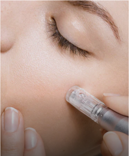 Close-up of a microneedling pen treating the skin on a client's cheek